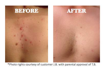 Organic Sea Salt Spray for Face, Body, and Hair, Acne and Rosacea Toner