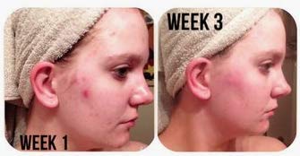 Organic Sea Salt Spray for Face, Body, and Hair, Acne and Rosacea Toner