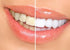 Bright White Smiles Wholesale Teeth Whitening Refill Gel Kit, 4 Syringes, 44% Carbamide Peroxide Bleaching Product