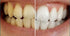 Ollie Teeth Whitening Strips, 24 Strips, 12 Treatments with Shade Guide