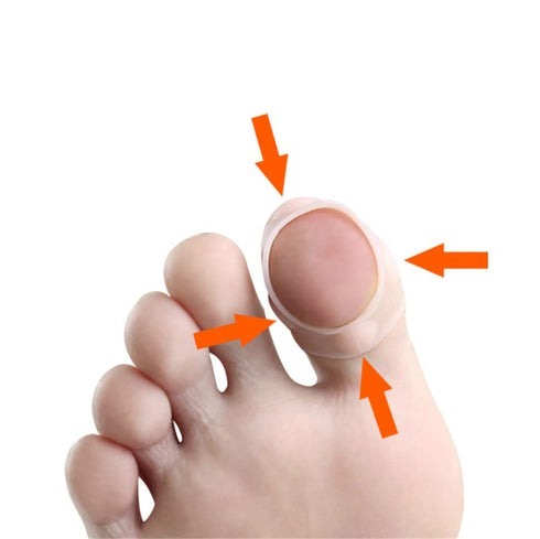 Ingrown Toenail Corrector Sleeves - 4 Pairs Elastic Silicone Tool for Thick Paronychia Treatment