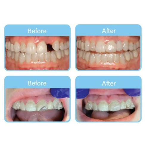 Aligner Pontics, Temporary Tooth Replacement for Aligner Trays and Retainers, 32 Count