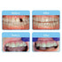Aligner Pontics, Temporary Tooth Replacement for Aligner Trays and Retainers, 32 Count