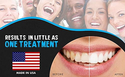 Bright White Smiles Wholesale Teeth Whitening Refill Gel Kit, 4 Syringes, 44% Carbamide Peroxide Bleaching Product