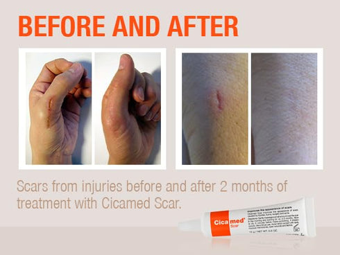 Silicone Scar Gel - Advanced Cream for Surgical Scars, C-Section, Burns, Keloids, Acne Marks - 0.5 oz (15g) - Works