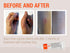 Silicone Scar Gel - Advanced Cream for Surgical Scars, C-Section, Burns, Keloids, Acne Marks - 0.5 oz (15g) - Works