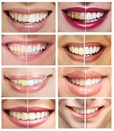 White Teeth Global 44% 6 Teeth Whitening Gel Carbamide Peroxide, Tooth Bleaching Gel Syringes