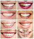 White Teeth Global 44% 6 Teeth Whitening Gel Carbamide Peroxide, Tooth Bleaching Gel Syringes