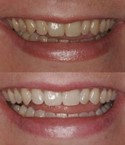ProDental Teeth Whitening Gel Syringe Refill - 10 Pack, 35% Carbamide Peroxide for Faster Results