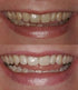 ProDental Teeth Whitening Gel Syringe Refill - 10 Pack, 35% Carbamide Peroxide for Faster Results