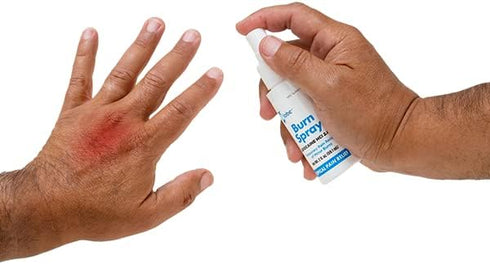 Globe Burn Spray, 2 oz Lidocaine 2% Topical Anesthetic Pain Relief and Numbing Spray (3 Pack)