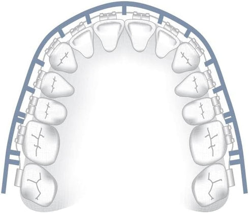Comfort Cover for Braces, Lip Protector Mouth Guard, Teeth Shield Bumper for Brackets and Aligners