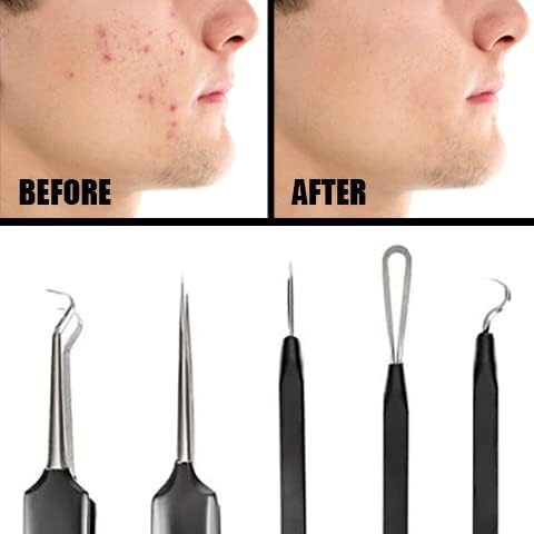 Pete & Pedro Acne & Blackhead Remover Tool Set - 5 Piece Pimple Popper Kit with Mirror for Men & Women