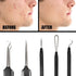 Pete & Pedro Acne & Blackhead Remover Tool Set - 5 Piece Pimple Popper Kit with Mirror for Men & Women