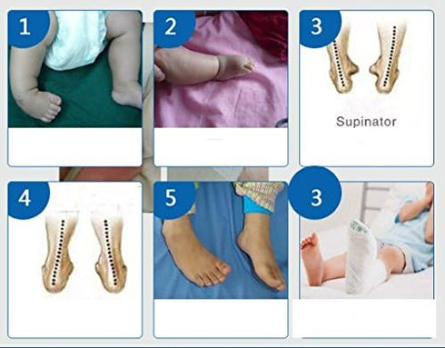 Kids AFO Drop Foot Splint Baby Ankle Foot Brace Night Splint for Toddler Strephenopodia Strephexopodia (12cm)
