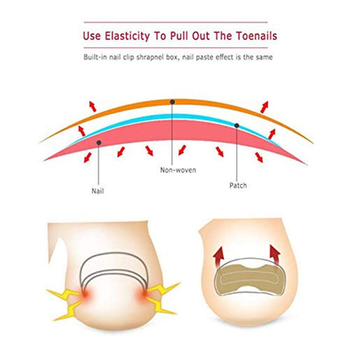 Ingrown Toenail Correction Patch, 50 Pcs Glue-free Stickers for Professional Foot Care