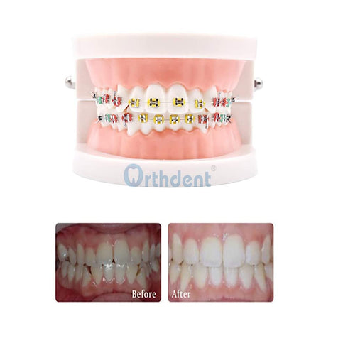2080Pcs, 2 Bags, Braces Rubber Band, Dental Orthodontics Elastic Ligature Ties Multi Color Rubber Band (1040pcs/bag)