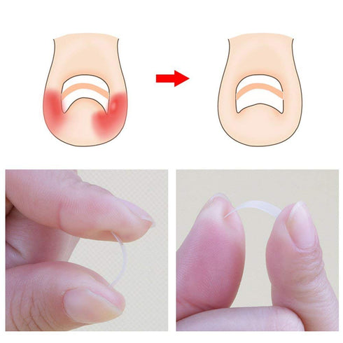 Ingrown Toenail Corrector Strips Brace - 10pcs/bottle - Straightener Clip for Thick Toenails