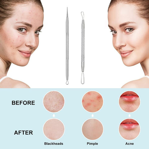 La chat Pimple Extractor Tools, Blackhead Remover, Acne Removal Kit for Blemish and Whitehead Treatment (2PCS)