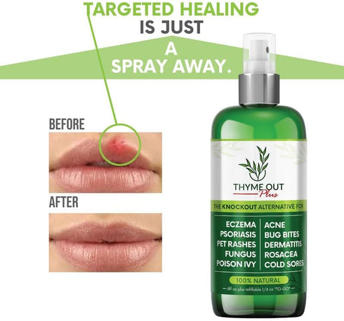 Thyme Out Plus Eczema Treatment, Psoriasis Treatment Treats Acne, Dermatitis, Rosacea, Cold Sores, Pet Rashes, Bug