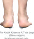 Knock-Knees Bow Legs O/X Type Medial & Lateral Heel Wedge Insoles for Knee Pain, 1 Pair