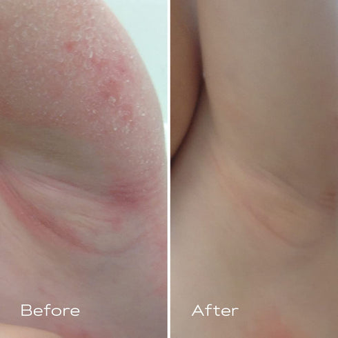 KAMEDIS Eczema Therapy Soothing Body Cream, Botanicals-based, Clinically Proven for Dry Skin