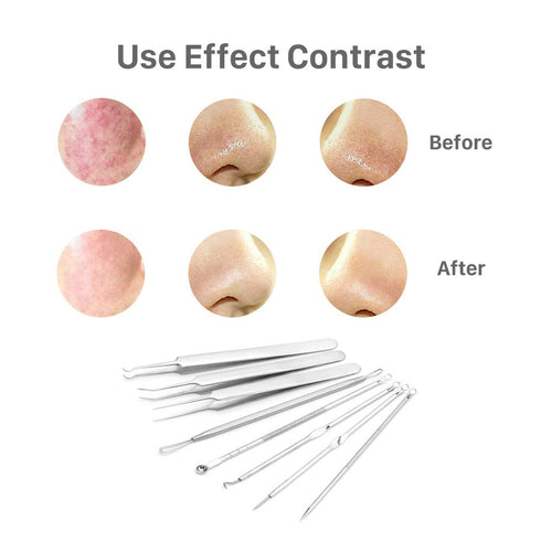 Pinkiou Blackhead Removers | 8-in-1 Acne Extractor Tool Kit for Face and Nose | Blemish Removal Skincare