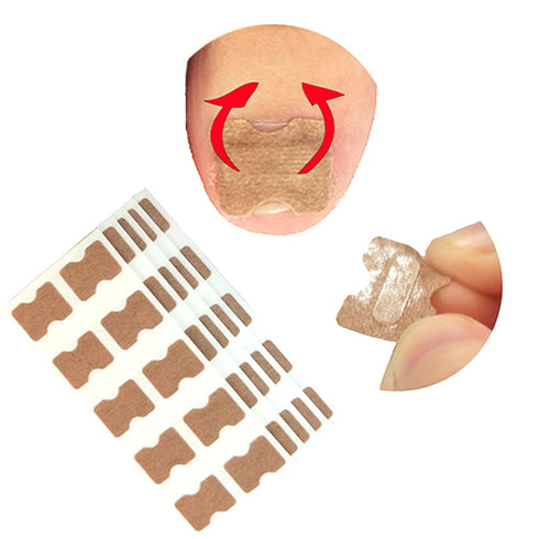 Ingrown Toenail Treatment - 50pcs Correction Stickers, Health Toenail Corrector Patches, Glue-Free Treatment Tool
