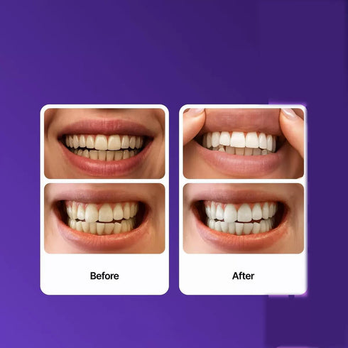 OSFRIAGE 14 Purple Teeth Whitening Strips,Gentle Daily Stain Reduction & Natural Shine, Portable for Home or On-The-Go