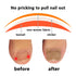 Ingrown Toenail Treatment, 50pcs Ingrown Toenail Correction Stickers, Health Toenail Corrector Patches, Professional Glue-Free Toe Nail Treatment Tool,Foot care