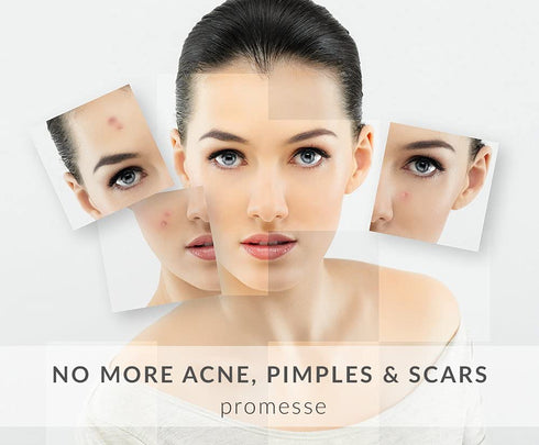 promesse Acne Control Facial Cleanser - Anti-Aging Exfoliating Wash with Organic & Natural Ingredients, Rose-Scented,