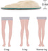 Dr. Foot's Corrective Shoe Inserts - Supination & Over-Pronation Medial & Lateral Heel Wedge Insoles, 3 Pairs Beige