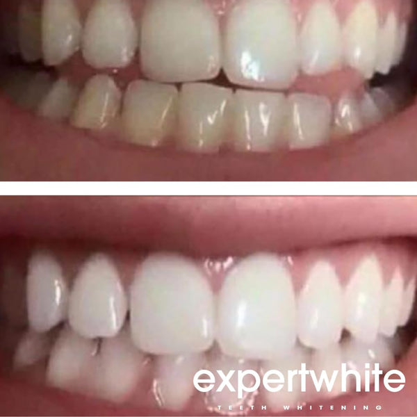 44% Teeth Whitening Gel Syringe Refill Pack for Aligner Trays, 4 gels (3cc Each), Made in USA, 15-Minute Treatment