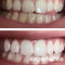 44% Teeth Whitening Gel Syringe Refill Pack for Aligner Trays, 4 gels (3cc Each), Made in USA, 15-Minute Treatment