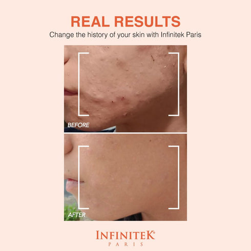 Infinitek Paris Vitamin C Face Serum, Hydrating Brightening Antioxidant Skincare with Hyaluronic Acid