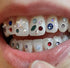 Sweet Smile | The ALL IN ONE DIY Tooth Gem Kit | Gold, Multi-Color, Clear Crystal Gems | Tooth Jewelry | Heart, Star