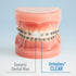 OrthoDots CLEAR – Moisture Activated Braces Wax Alternative for Pain Relief from Braces and Orthodontic Appliances