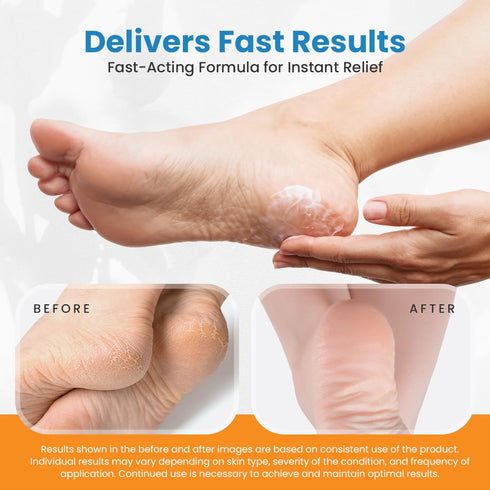 Revitaderm 4D Urea Cream 40 Percent for Feet, Maximum Strength, 4oz, Callus Remover, Free Pumice Stone