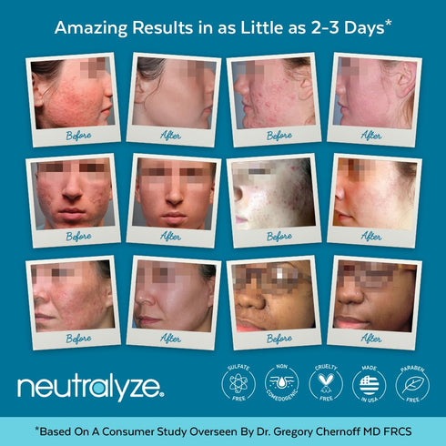Moderate to Severe Acne Treatment Kit 2.0 - Maximum Strength Acne Kit with 2% Salicylic Acid & Mandelic Acid - 90+ Day