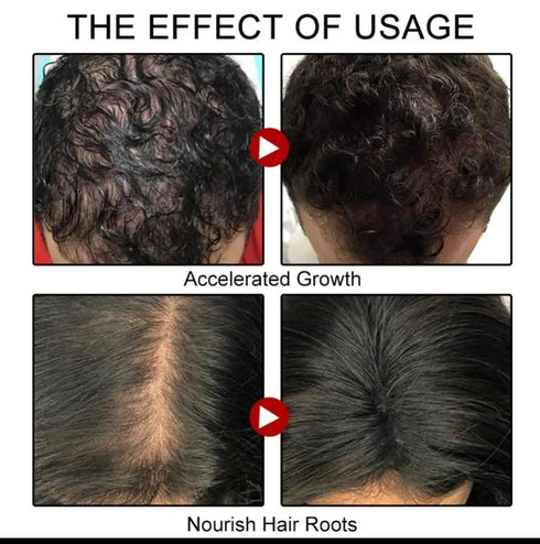 Ginger Hair Growth Spray | Promotes Thicker, Longer Hair with Ginger Extract for Scalp Moisturization and Regrowth