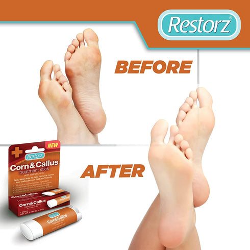 Corn and Callus Remover Stick with Salicylic Acid (1 Pack) - Portable Ointment Applicator for Gentle Removal