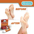 Corn and Callus Remover Stick with Salicylic Acid (1 Pack) - Portable Ointment Applicator for Gentle Removal