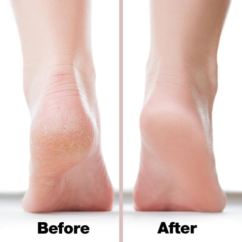 Probelle Double Sided Multidirectional Nickel Foot File Callus Remover - Safe Tool for Instant Results (Pink)