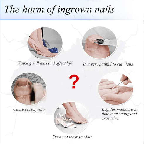 Ingrown Toenail Correction Patch, 50 Pcs Glue-free Stickers for Professional Foot Care