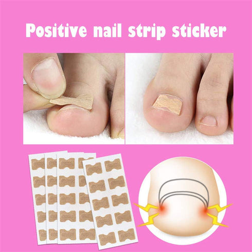Ingrown Toenail Correction Patch, 50 Pcs Glue-free Stickers for Professional Foot Care