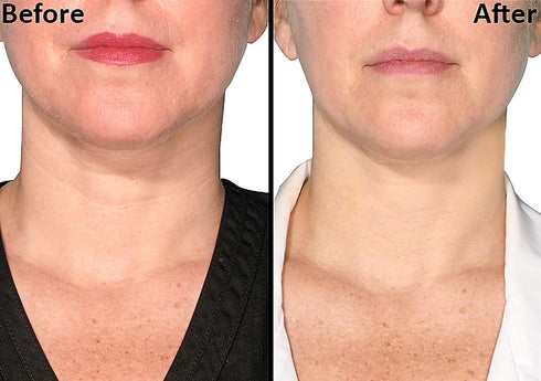 Neck Wrinkle Patches x 2, Anti-Aging Silicone Treatment for Skin Firming (16 Day Supply)