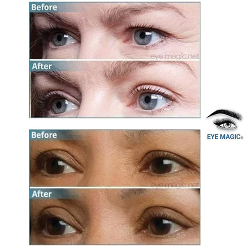 Original Eye Lift Kit, Small/Medium Size with Gel, Lifts Eyelid Droop and Hooded Eyes