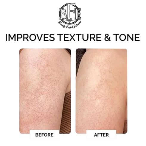 Keratosis Pilaris Exfoliating Body Lotion – 12% Lactic Acid for Gentle Exfoliation & Moisture