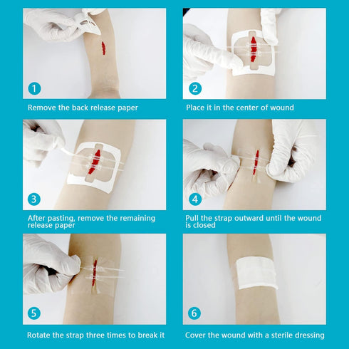 Zip Stitch Emergency Wound Closure Strips, 4 Pcs Laceration Closure Kit for Wounds without Stitches, Butterfly Bandaids
