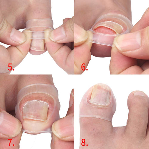 Silicone Ingrown Toenail Corrector, Treatment Tool for Nail Care, 1 Pair for Pedicure Recovery